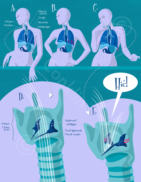 Hiccups